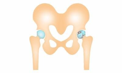 Avascular necrosis of the hip joint