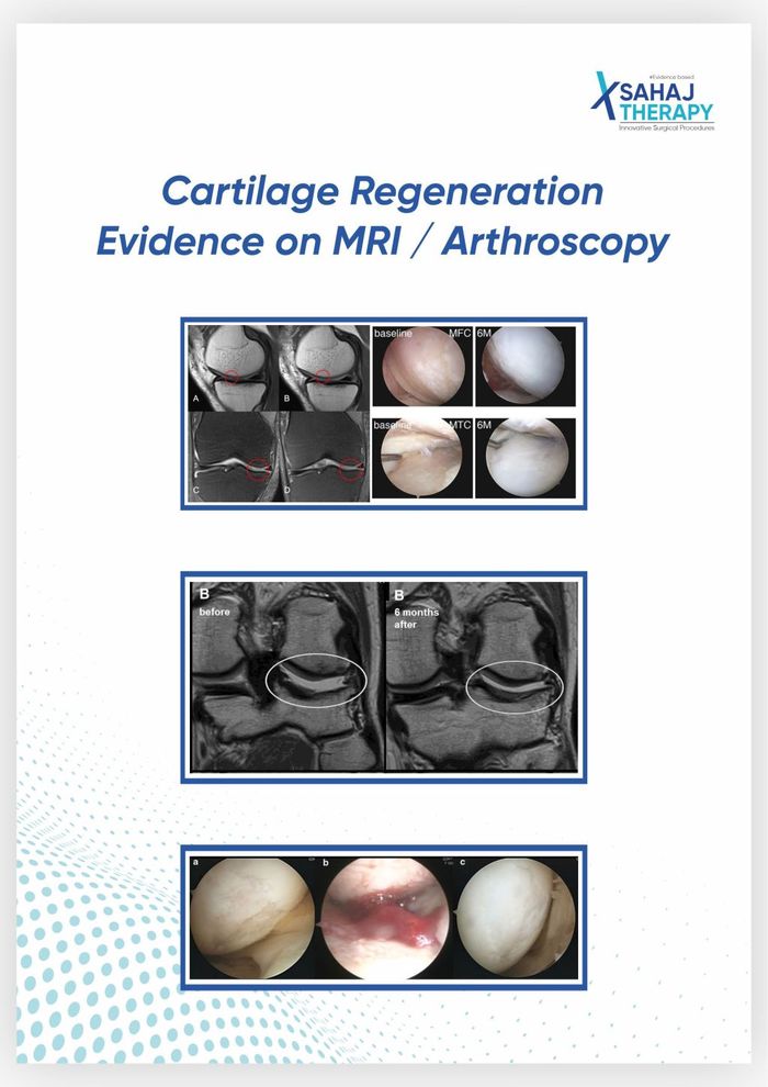 MRI and arthroscopic evidences for adipose cellular fraction (SVF)