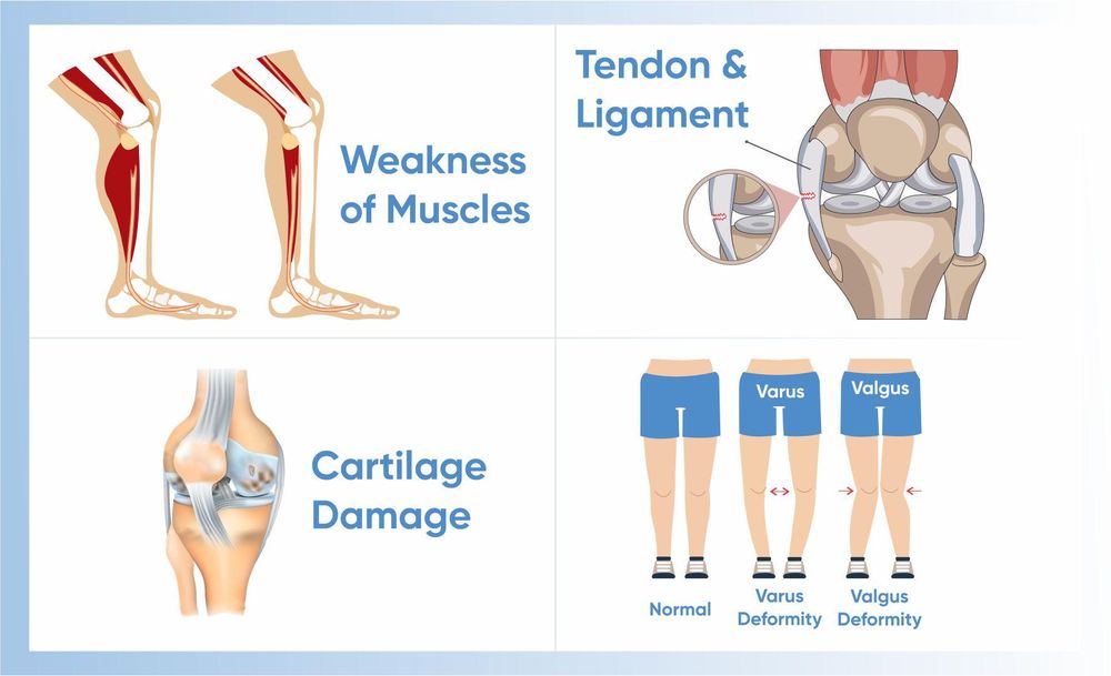 Causes of osteoarthritis