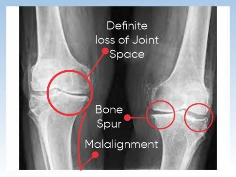 Diagnosis of osteoarthritis