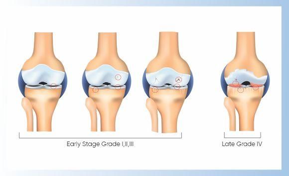 Stages of osteoarthritis