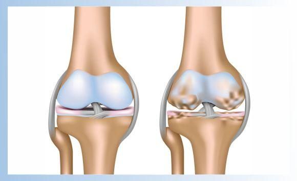 Osteoarthritis
