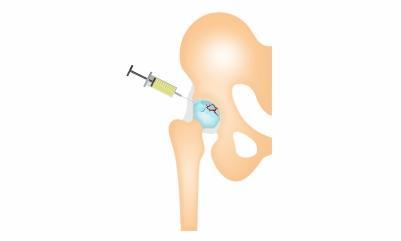 SVF therapy: