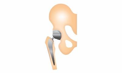 Hip Replacement